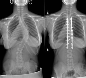 Right Thoracic Scoliosis