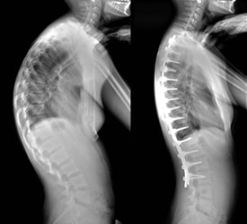 Scheuermann’s Kyphosis