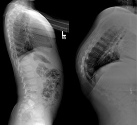 Normal Spine vs Kyphosis
