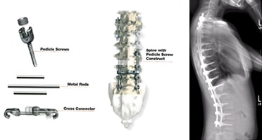 Pedicle Screws